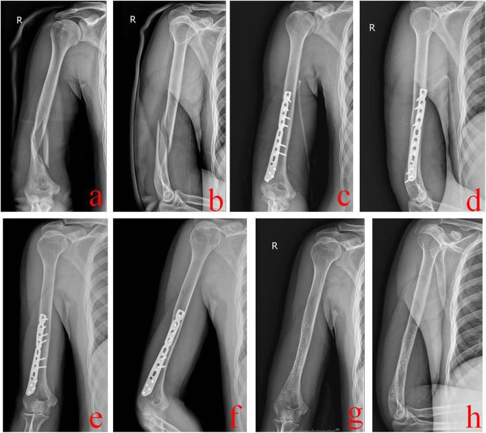 Preoperative and postoperative radiographs of humeral shaft fracture anterograde intramedullary nailing