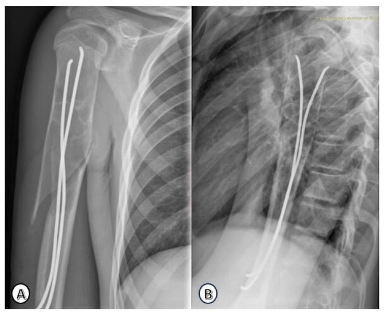 Postoperative radiographs of pediatric humeral shaft fracture titanium elastic nailing