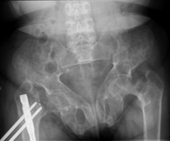 AP pelvis radiograph showing multiple lytic brown tumors and surgically fixed hip fracture in a patient with hyperparathyroidism