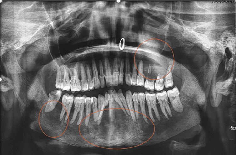 Orthopantomogram with three circled radiolucent jaw lesions in primary hyperparathyroidism