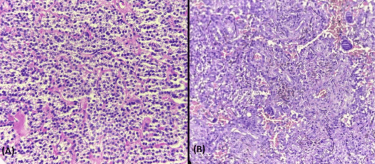 Histology comparing a parathyroid adenoma with a brown tumour containing osteoclast-type giant cells