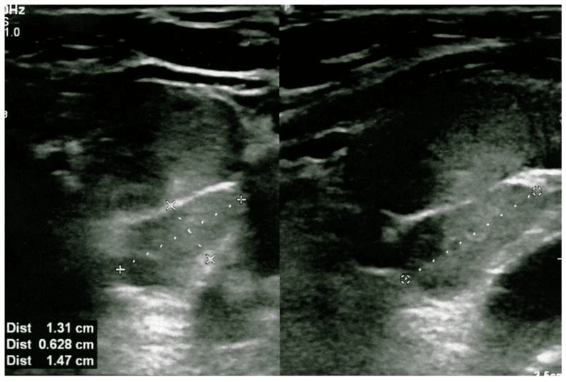 Neck ultrasound in two views showing a hypoechoic parathyroid adenoma measured with calipers
