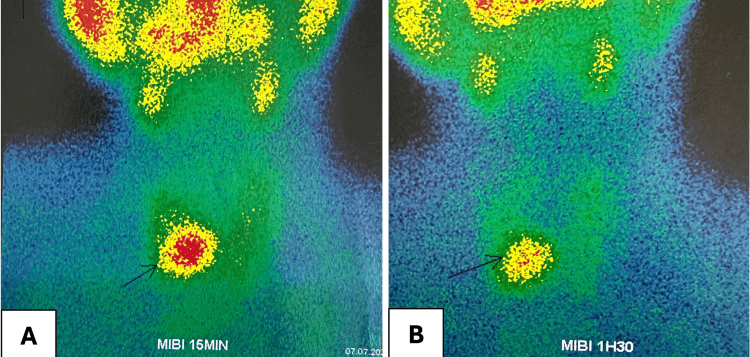 Technetium-99m sestamibi scans at 15 minutes and 1 hour 30 minutes showing persistent focal uptake in the right lower neck