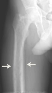 Proximal femur radiograph with arrows indicating a thin periosteal reaction along the cortex in renal osteodystrophy