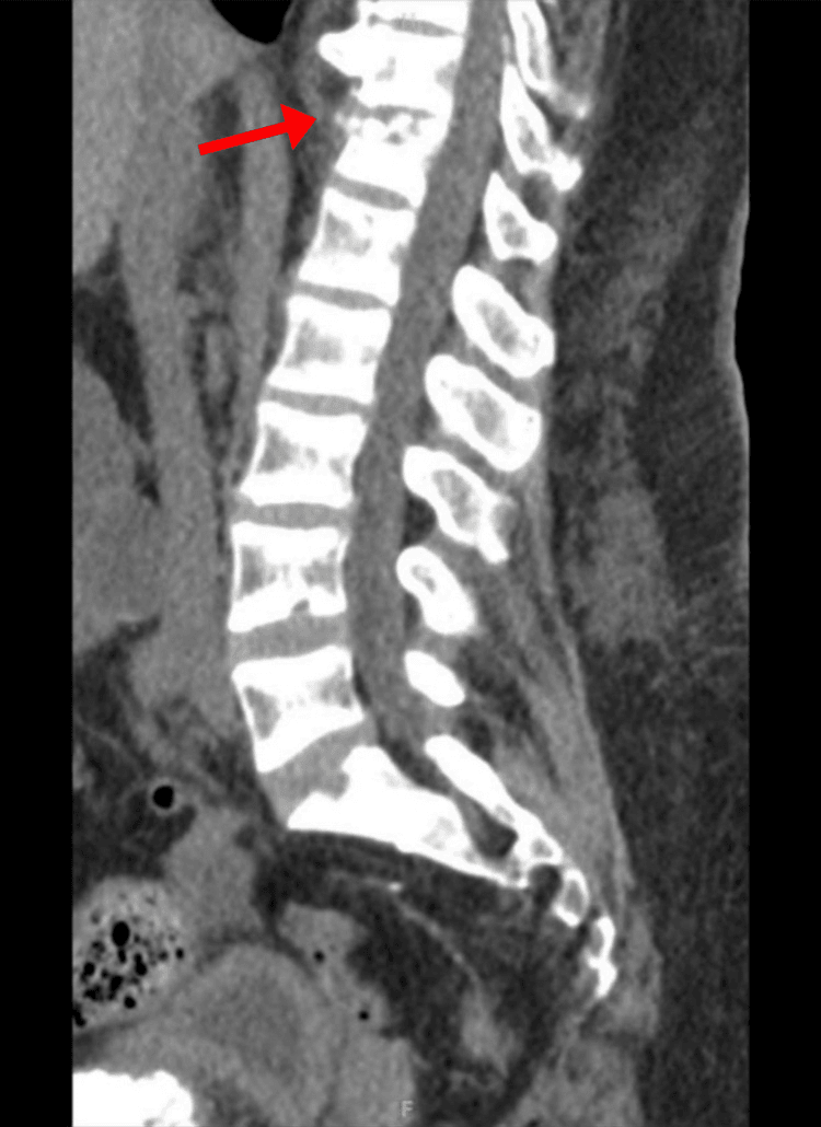 Sagittal spinal CT showing rugger-jersey endplate sclerosis and a vertebral compression fracture marked by an arrow