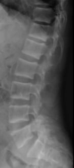 Lateral lumbar spine radiograph showing rugger jersey spine with dense sclerotic bands at the vertebral endplates in renal osteodystrophy