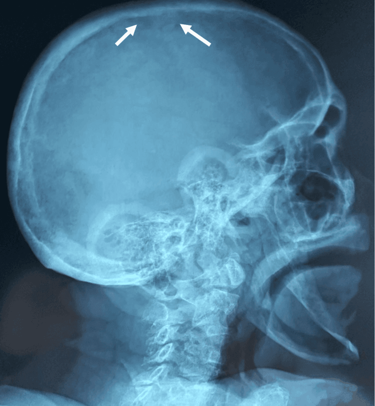 Lateral skull radiograph with arrows at the vault marking granular salt-and-pepper demineralisation in hyperparathyroidism