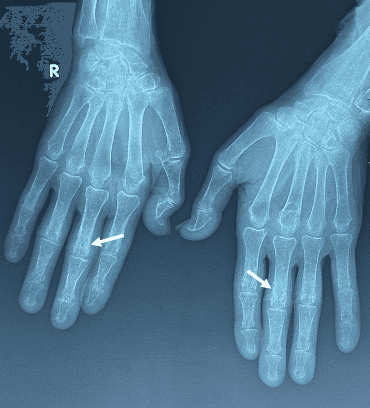 Bilateral hand radiographs with arrows marking subperiosteal cortical resorption along the phalanges