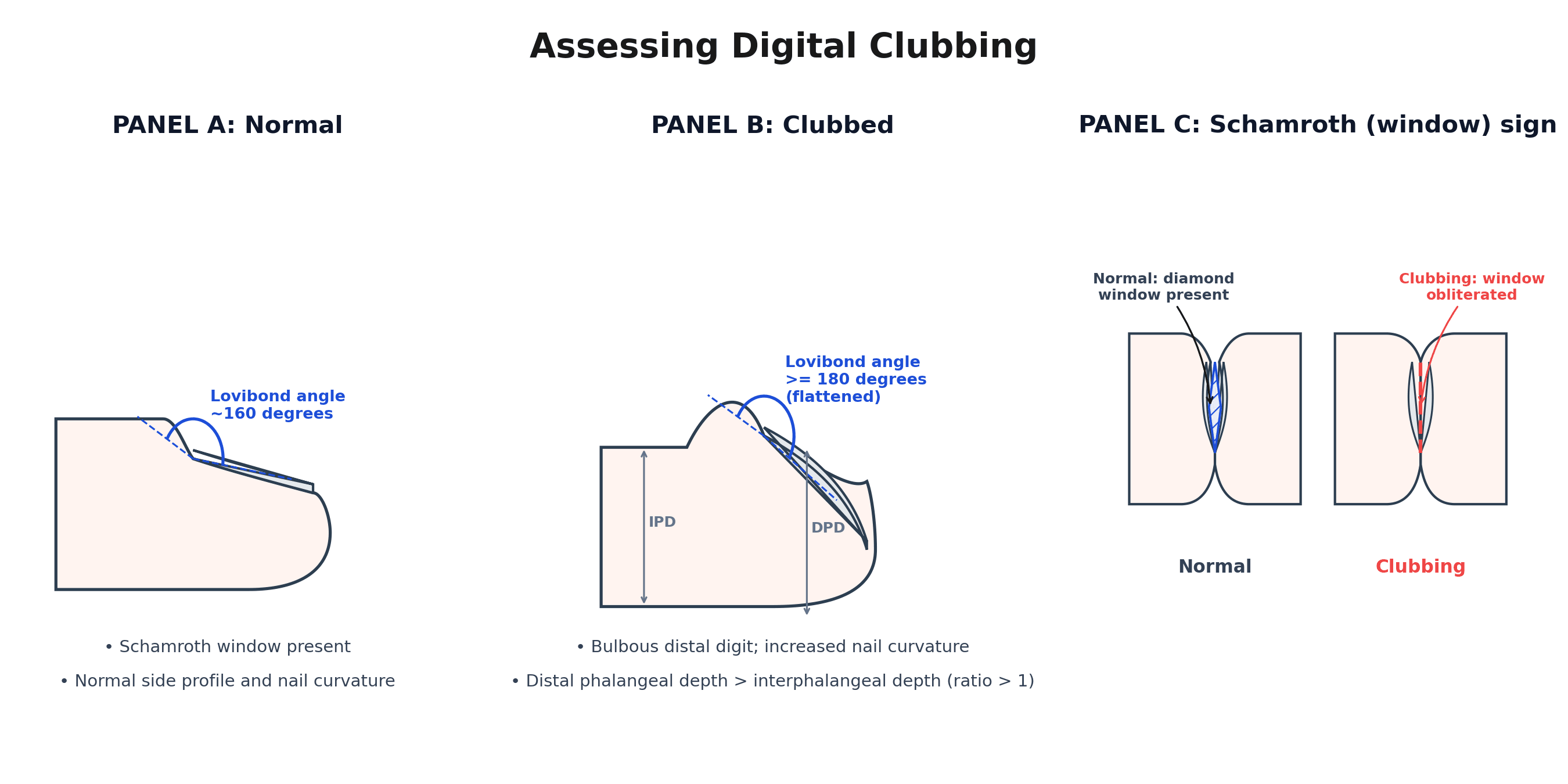 Schematic of digital clubbing: normal fingertip with a Lovibond angle of about 160 degrees, a clubbed drumstick fingertip with a flattened angle of 180 degrees or more, and the Schamroth window sign normal versus obliterated