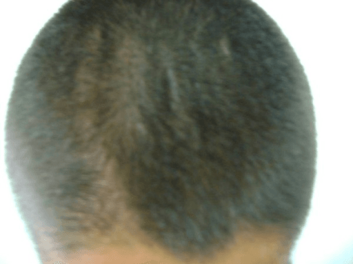 Cutis verticis gyrata of the scalp in primary hypertrophic osteoarthropathy (pachydermoperiostosis)