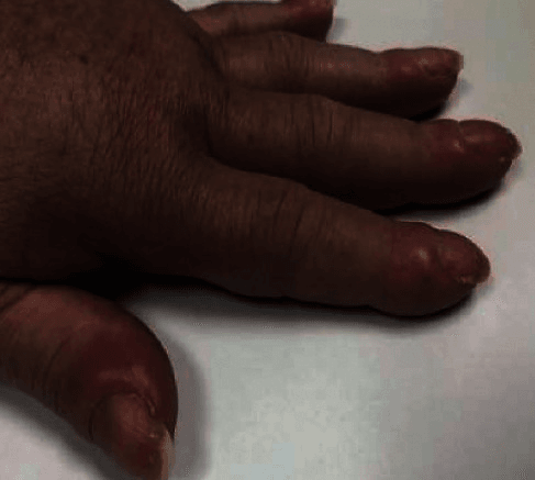 Clinical photograph of digital clubbing of the distal phalanges in hypertrophic osteoarthropathy