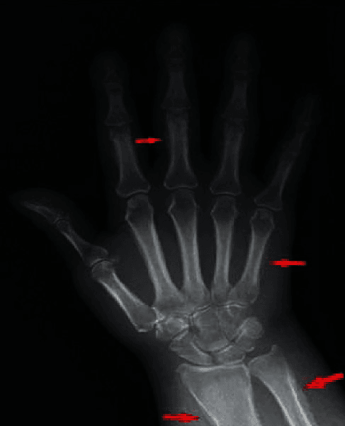 Hand radiograph showing periosteal thickening of the metacarpals, proximal phalanges, distal radius and ulna in hypertrophic osteoarthropathy