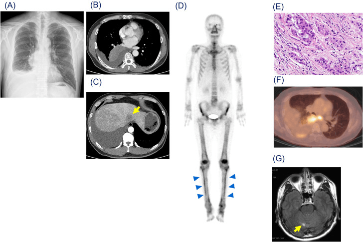 Chest radiograph showing a right pleural effusion and chest CT showing a large right lower lobe mass in a patient with hypertrophic pulmonary osteoarthropathy
