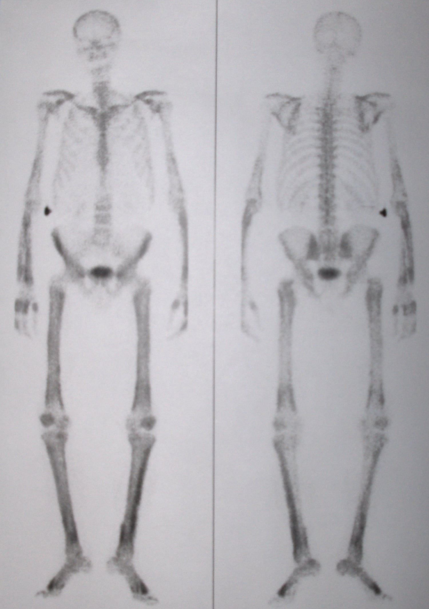 Whole-body bone scan (anterior and posterior) of a patient with hypertrophic osteoarthropathy showing symmetric increased tracer uptake along the long bones