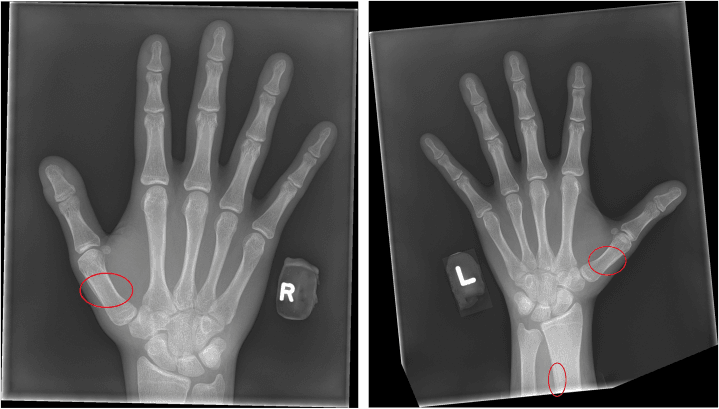 Hand radiographs in pachydermoperiostosis showing periosteal reactions along the first metacarpal shafts and distal radius