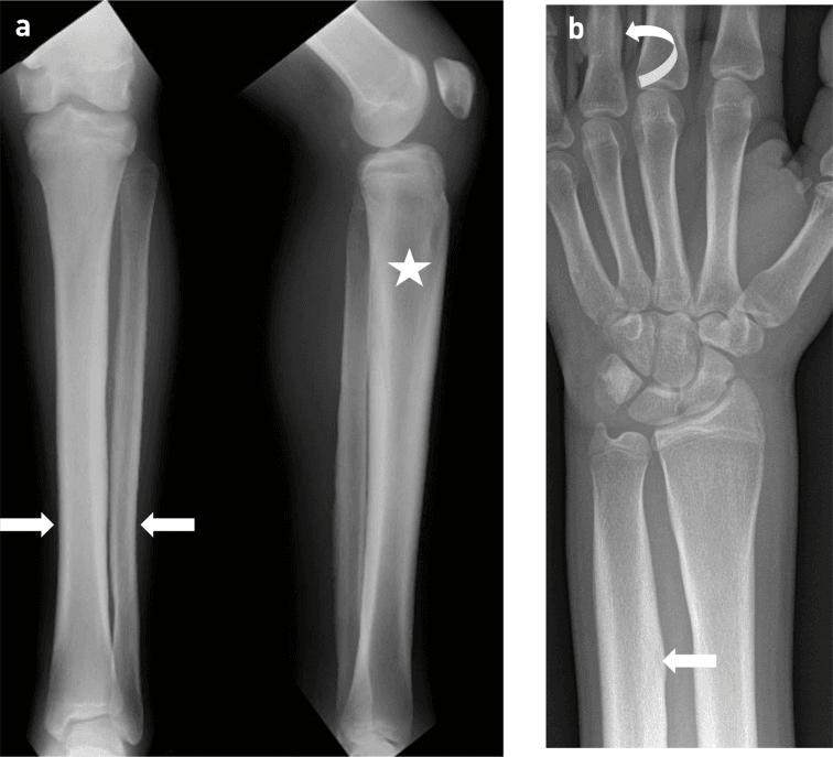 AP and lateral radiographs of the lower leg showing diffuse lamellar periosteal reaction and cortical thickening of the tibia and fibula in primary hypertrophic osteoarthropathy
