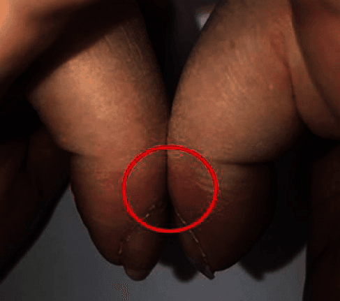Schamroth window sign in hypertrophic osteoarthropathy showing obliteration of the normal diamond-shaped gap between opposed terminal phalanges