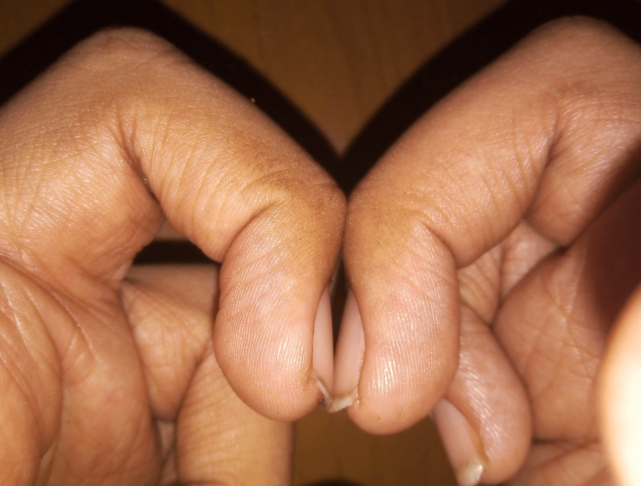 Normal Schamroth window test showing the preserved diamond-shaped gap between opposed terminal phalanges