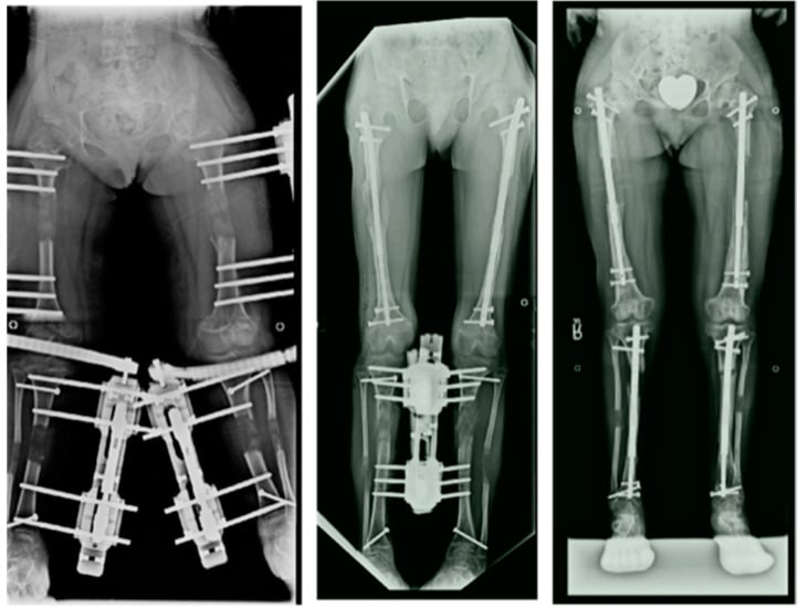 Radiographs of external, hybrid and internal four-segment limb-lengthening constructs