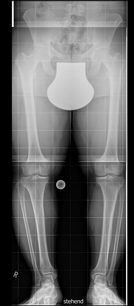 Standing anteroposterior lower-limb radiograph in hypochondroplasia