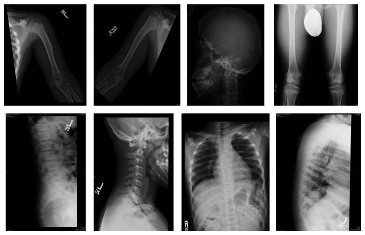 Composite skeletal survey radiographs of a child with hypochondroplasia