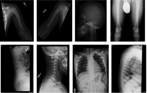 Skeletal survey in hypochondroplasia showing rhizomelic long-bone shortening and lack of lumbar interpedicular widening