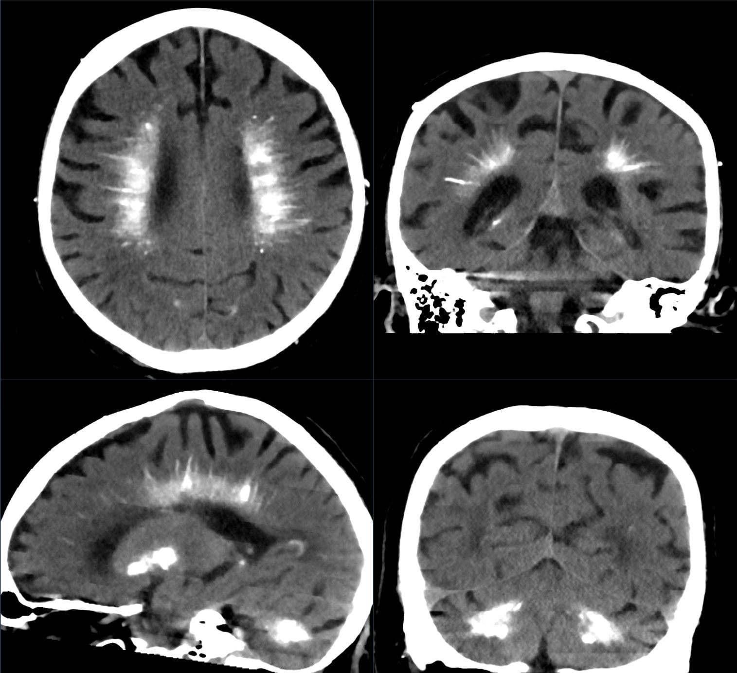 Non-contrast CT brain showing bilateral basal ganglia and cerebellar dentate nucleus calcification, the radiologic pattern seen in chronic hypoparathyroidism.