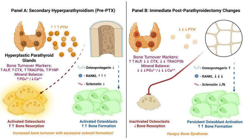 Two-panel diagram: (A) secondary hyperparathyroidism before parathyroidectomy with activated osteoclasts and osteoblasts; (B) immediately after parathyroidectomy with inactivated osteoclasts and persistent osteoblast activation, labelled hungry bone syndrome