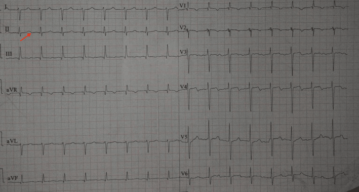 Twelve-lead ECG from a case of hypocalcaemia with QT prolongation, a red arrow on lead II