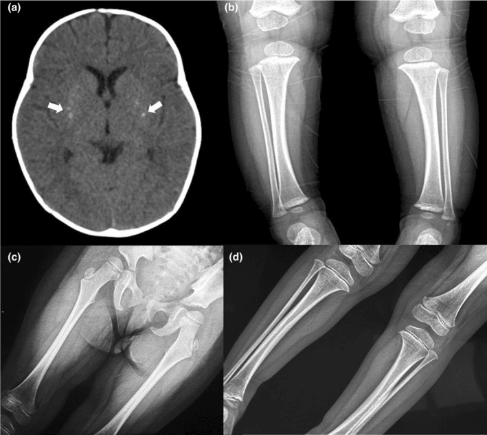 Kenny-Caffey syndrome: (a) axial CT with arrows on bilateral basal ganglia calcification; (b-d) limb radiographs of long bones with thick cortices and narrow medullary canals