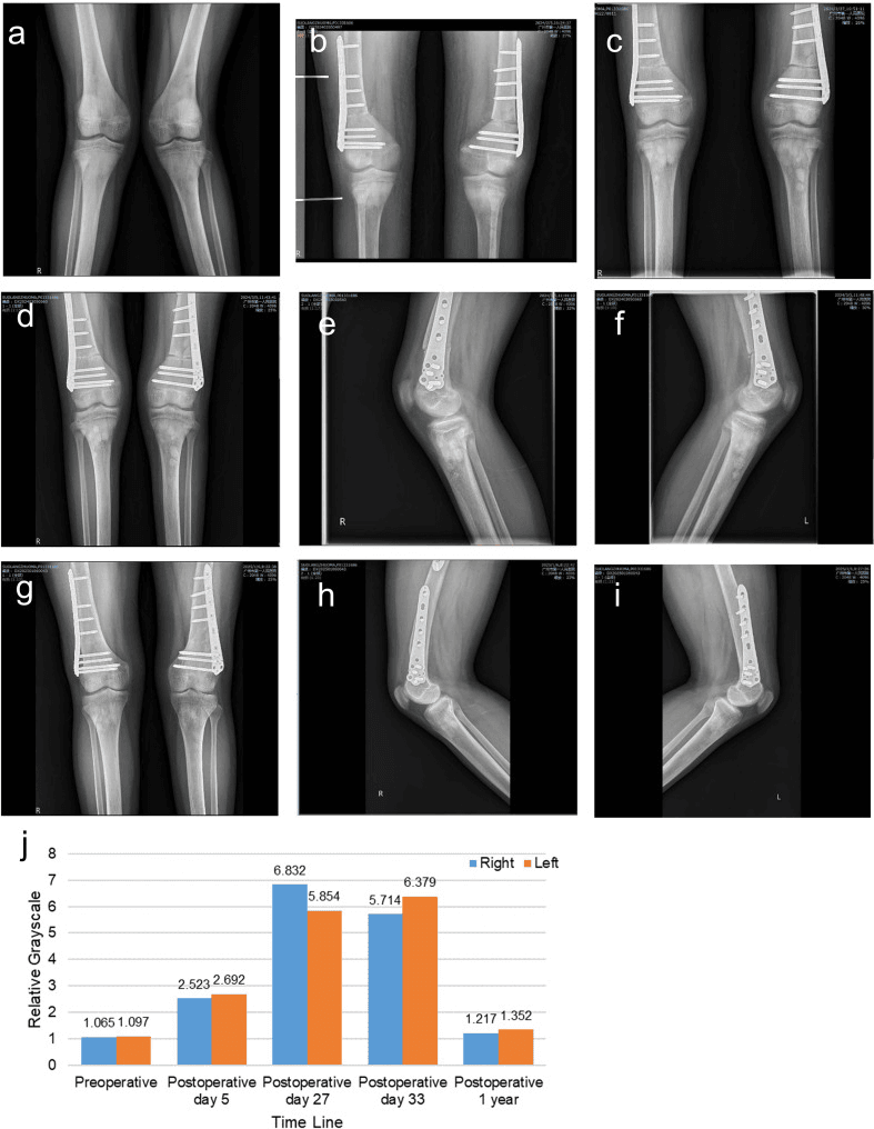 Serial knee radiographs (a-i) and a bar chart of relative bone greyscale (j) showing transient metaphyseal osteosclerosis after parathyroidectomy