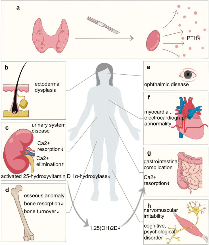 Diagram of postsurgical hypoparathyroidism: surgery lowering PTH (a) and its effects on skin, urinary system, bone, eye, heart, gut and neuromuscular function (b-h)