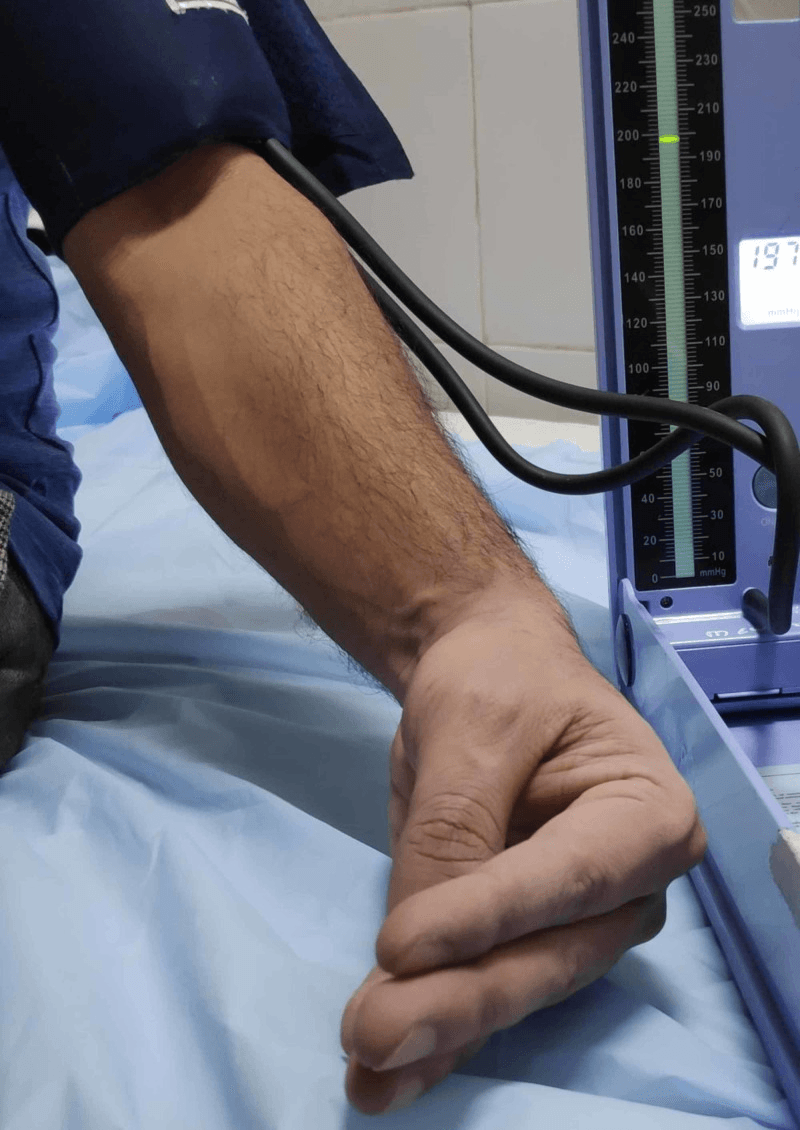 Trousseau sign: forearm with an inflated blood-pressure cuff, the gauge reading about 200 mmHg, and the hand in carpopedal spasm with the wrist flexed and thumb adducted