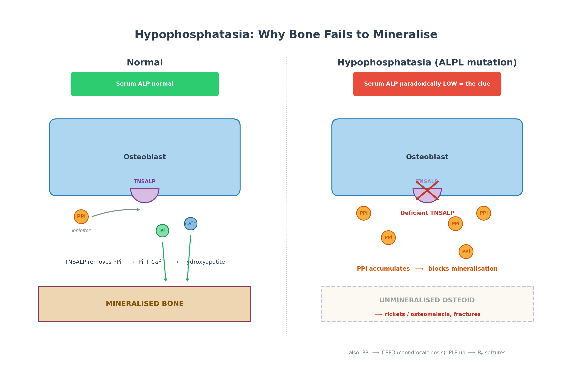 Mechanism diagram contrasting normal bone mineralisation with hypophosphatasia: TNSALP normally removes the mineralisation inhibitor PPi, but a deficient enzyme lets PPi accumulate and block mineralisation, with a paradoxically low serum ALP