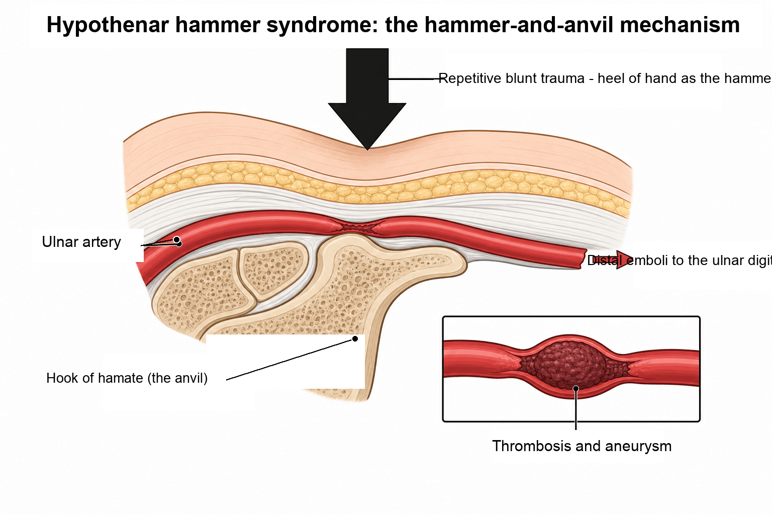 Schematic of the hammer-and-anvil mechanism: repetitive blunt trauma from the heel of the hand crushes the ulnar artery against the hook of the hamate, producing thrombosis, aneurysm and distal emboli to the ulnar digits