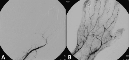 Hand angiogram before and after thrombolytic therapy showing arterial occlusion then restored filling