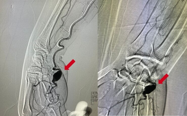 Arteriogram showing a superficial palmar ulnar artery aneurysm