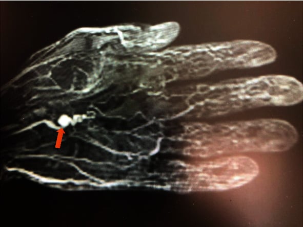 MR angiogram of a distal ulnar artery aneurysm with the corkscrew sign