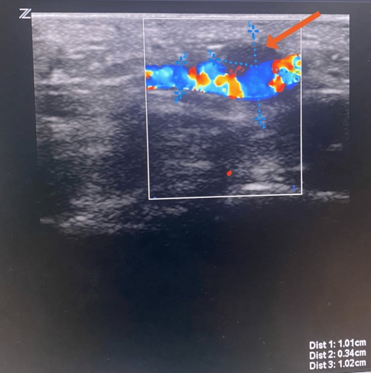 Colour duplex ultrasound of an ulnar artery aneurysm containing mural thrombus