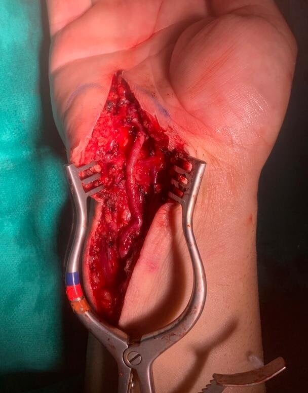 Draped intra-operative view of the ulnar artery after aneurysm resection and end-to-end anastomosis