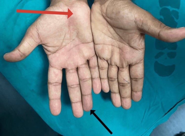 Palmar photograph of both hands showing a right hypothenar swelling and cyanosis of the right ring fingertip