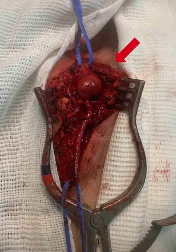 Draped intra-operative view of an ulnar artery aneurysm at the hypothenar eminence before resection