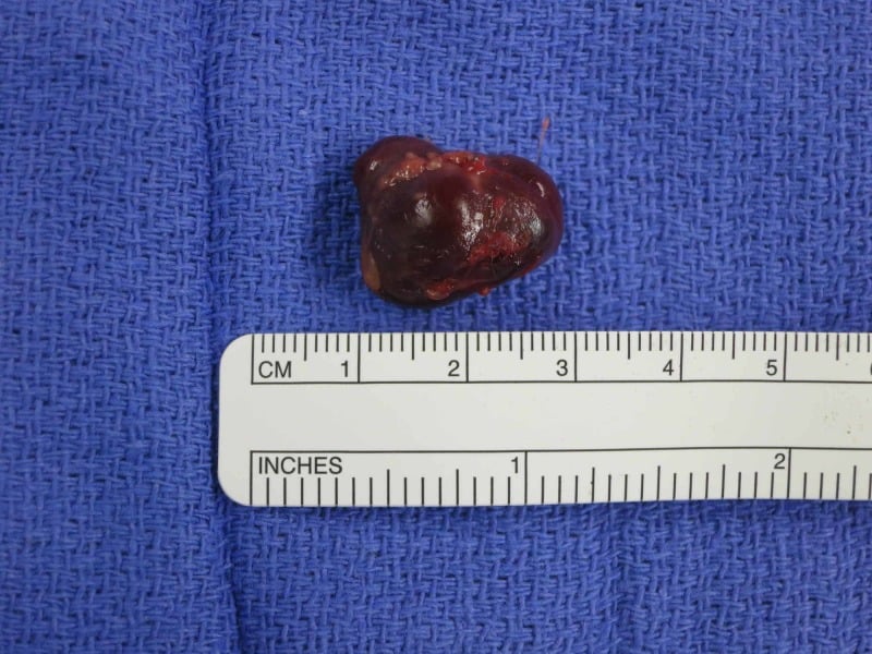 Resected ulnar artery pseudoaneurysm specimen