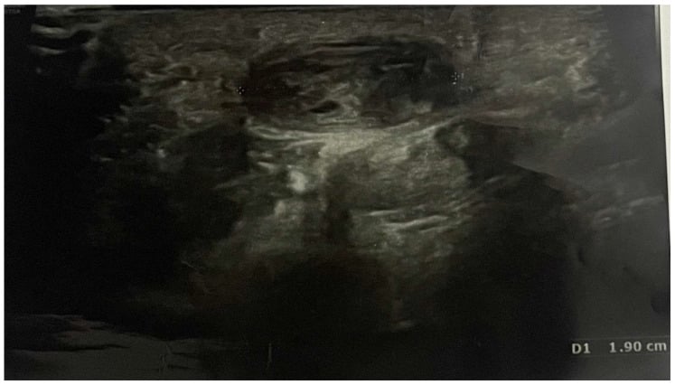 Greyscale ultrasound measuring a 19 mm ulnar artery aneurysm