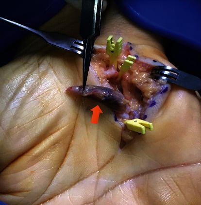 Draped intra-operative view of an ulnar artery aneurysm before interposition vein graft