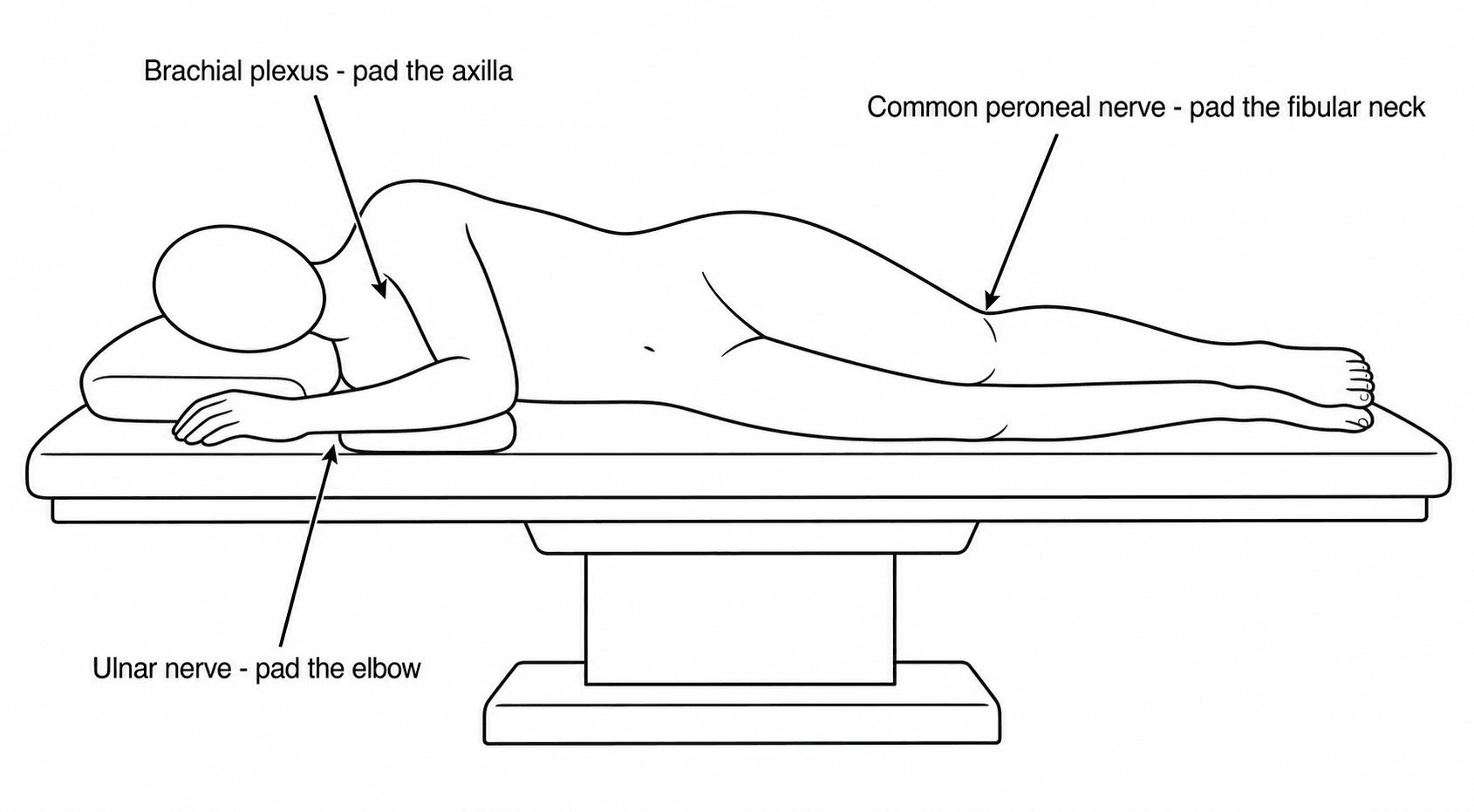Diagram of a patient in the lateral decubitus position showing at-risk nerves at the dependent axilla, fibular neck and elbow