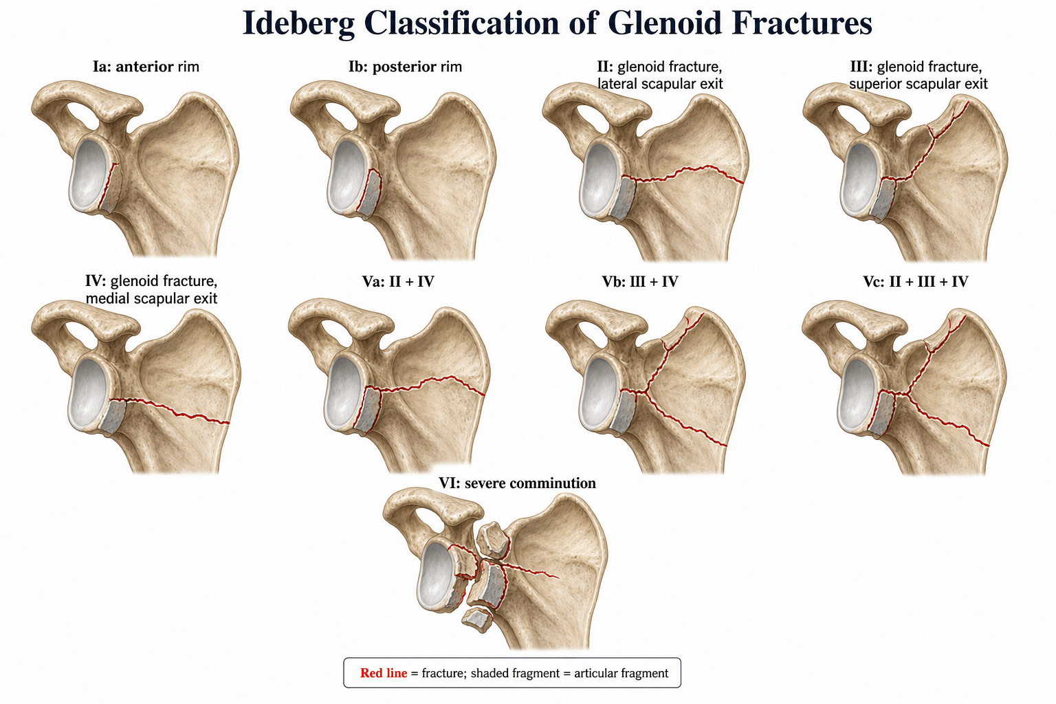 Ideberg Classification of Glenoid Fractures