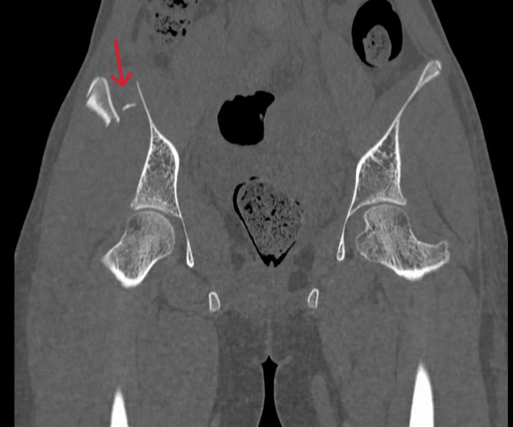 Posterior coronal CT of comminuted iliac-wing fracture