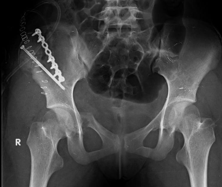 AP pelvis after plate and skiver-screw fixation