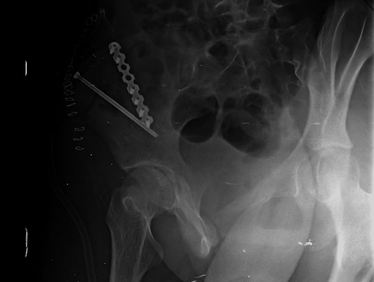 Iliac oblique Judet view after iliac-wing fixation